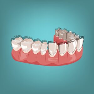 How long does Invisalign take to work?