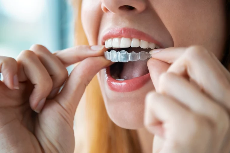 Close-up of a woman showing what is Invisalign by inserting clear aligner into her mouth with soft window light illuminating the scene.