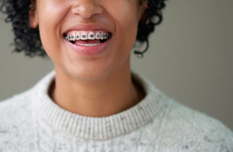 Girl with beautiful smile with metal braces, just one of the types of braces