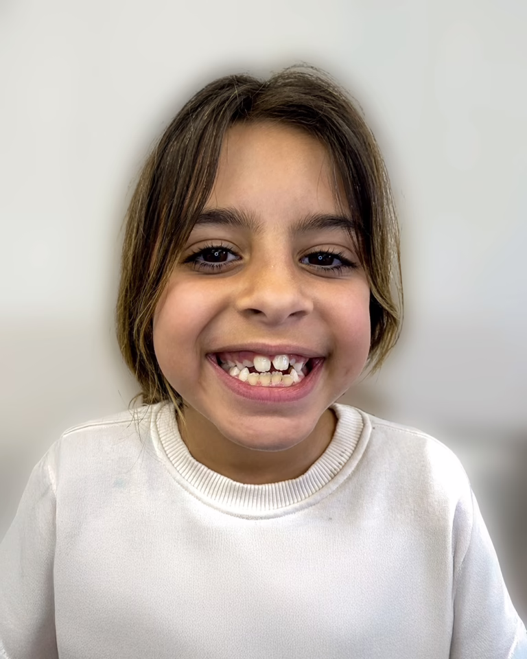 Girl patient smiling in Mira Mesa California after phase one orthodontic treatment with Dr. Joseph Phillips